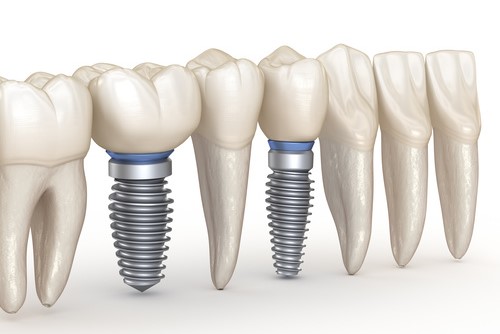 インプラント治療とは